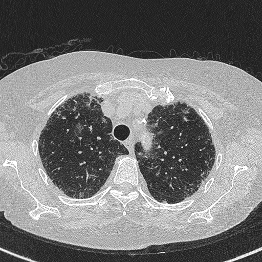 Amiodarone-induced pulmonary fibrosis (Radiopaedia 82355-96460 Axial lung window 17).jpg