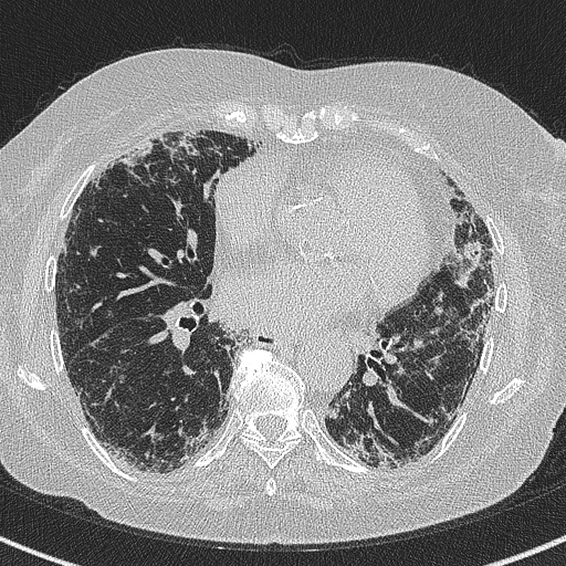 Amiodarone-induced pulmonary fibrosis (Radiopaedia 82355-96460 Axial lung window 41).jpg