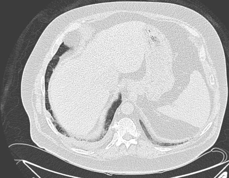 File:Amiodarone lung (Radiopaedia 62514-70769 Axial lung window 77).jpg