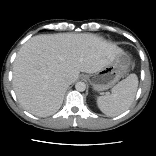 Amoebic liver abscesses (Radiopaedia 55536-62009 A 18).jpg