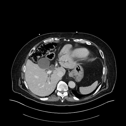 Ampullary adenocarcinoma (Radiopaedia 59373-66734 C 35).jpg
