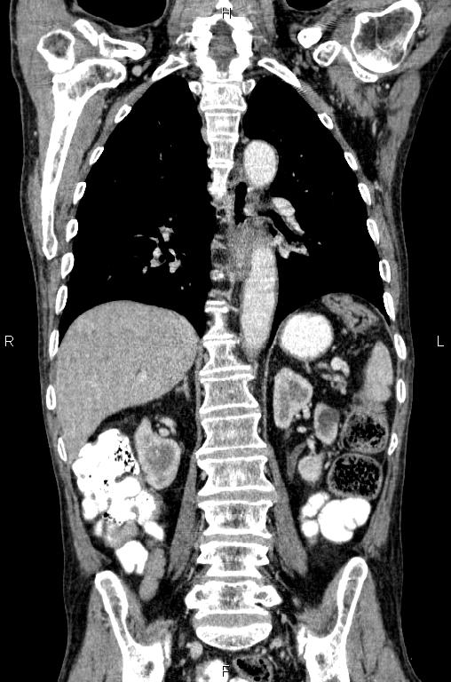 Ampullary adenocarcinoma (Radiopaedia 86093-102033 D 39).jpg