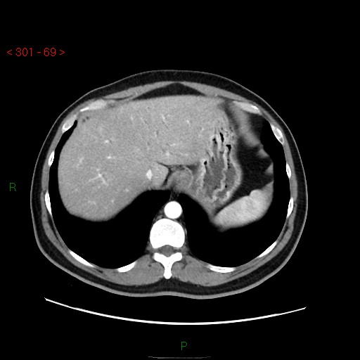 File:Ampullary carcinoma (Radiopaedia 56396-63056 B 15).jpg
