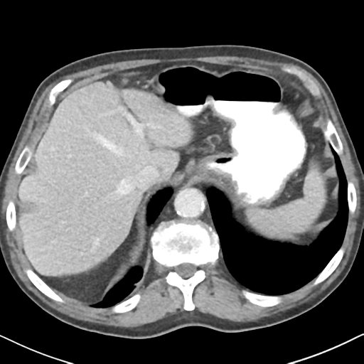 File:Amyand hernia (Radiopaedia 39300-41547 A 11).png