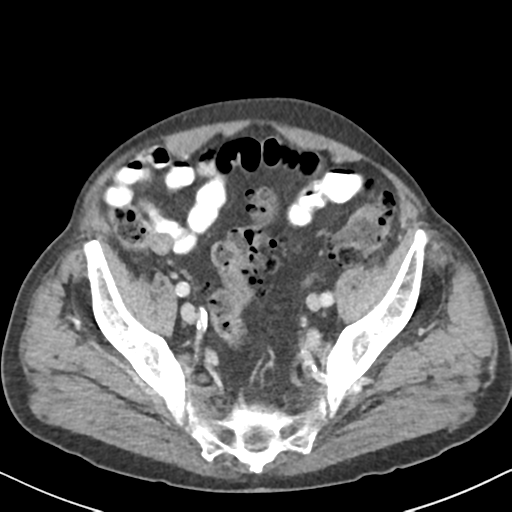 File:Amyand hernia (Radiopaedia 39300-41547 A 57).png