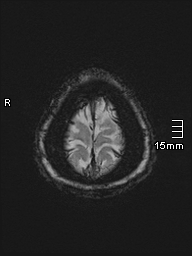 File:Amyotrophic lateral sclerosis (Radiopaedia 70821-81017 Axial SWI 56).jpg