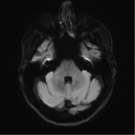 Anaplastic astrocytoma - thalamic glioma (Radiopaedia 59709-67115 Axial DWI 44).png