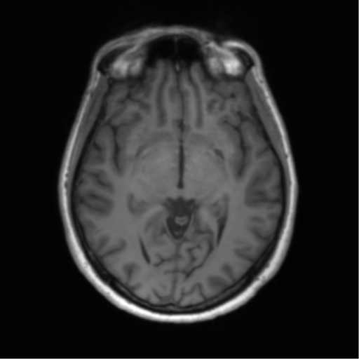 File:Anaplastic astrocytoma - thalamic glioma (Radiopaedia 59709-67115 Axial T1 11).png