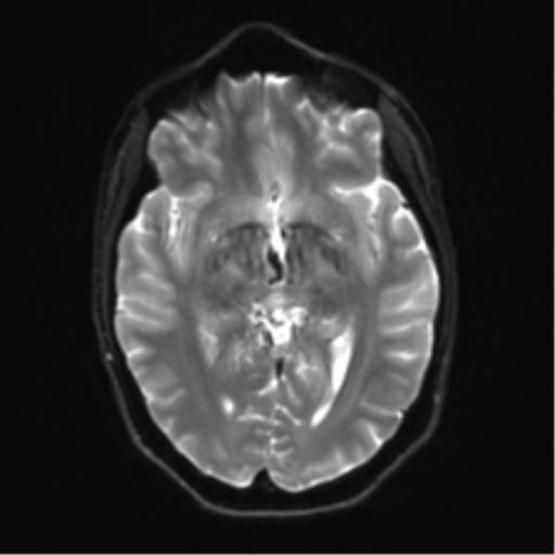Anaplastic astrocytoma IDH mutant (Radiopaedia 50046-55341 Axial DWI 13).png