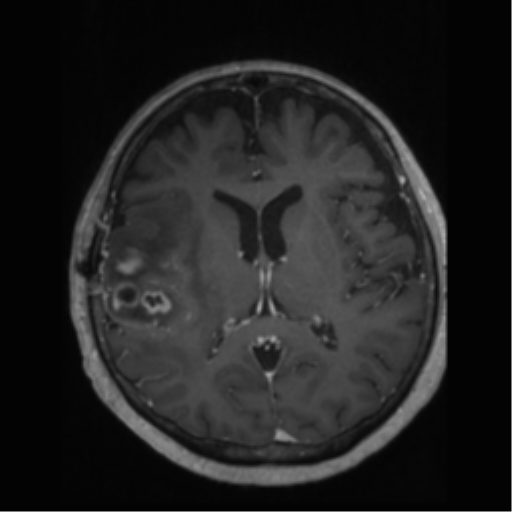 File:Anaplastic astrocytoma IDH wild-type (pseudoprogression) (Radiopaedia 42209-45277 Axial T1 C+ 69).png