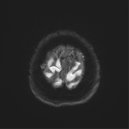 Anaplastic astrocytoma IDH wild-type (pseudoprogression) (Radiopaedia 42209-45279 Axial DWI 52).png