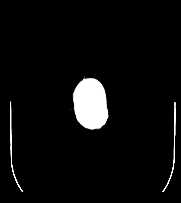 Anaplastic oligodendroglioma (Radiopaedia 79571-92755 Axial non-contrast 53).jpg