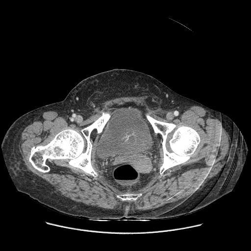 Anastomosis leak at ileostomy closure site (Radiopaedia 82138-96184 B 242).jpg