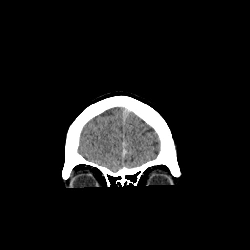 Aneursym related subarachnoid hemorrhage with hydrocephalus (Radiopaedia 45105-49083 Coronal non-contrast 7).jpg