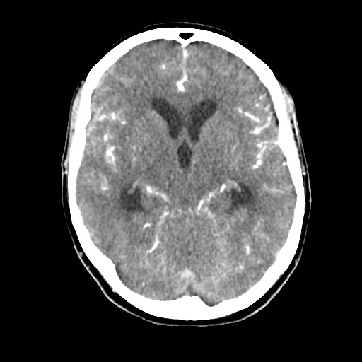 Aneursym related subarachnoid hemorrhage with hydrocephalus (Radiopaedia 45105-49084 D 23).jpg