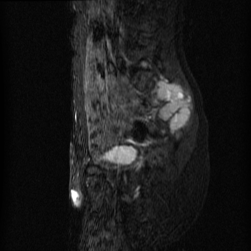 File:Aneurysmal bone cyst - sacrum (Radiopaedia 65190-74196 Sagittal STIR 13).jpg