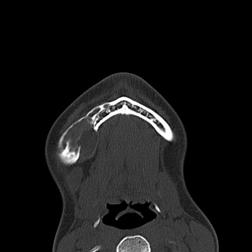 Aneurysmal bone cyst of the mandible (Radiopaedia 43280-46601 Axial bone window 6).jpg