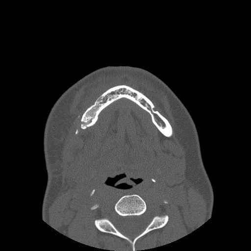 File:Aneurysmal bone cyst of the mandible (Radiopaedia 43280-46823 Axial bone window 30).jpg