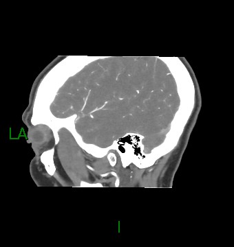 Aneurysmal subarachnoid hemorrhage with intra-axial extension (Radiopaedia 84371-99732 B 13).jpg