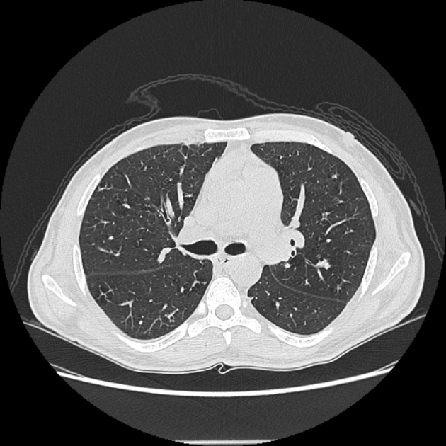 Angioinvasive aspergellosis (Radiopaedia 66995-76315 Axial lung window 21).jpg