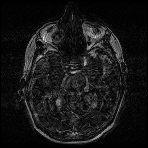 Angioinvasive aspergillosis in the pituitary fossa (Radiopaedia 39676-42010 Ax 3D FIESTA VOLUME 45).png
