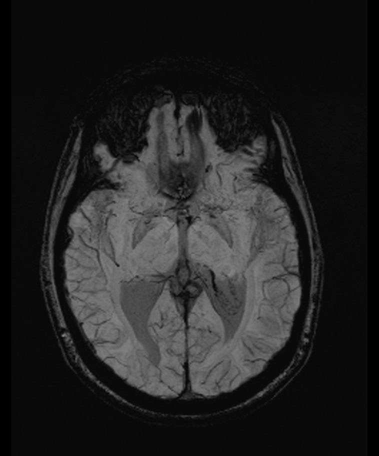 Angiomatous meningioma (Radiopaedia 79459-92579 E 32).jpg