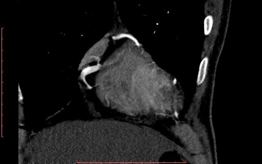 Anomalous left coronary artery from the pulmonary artery (ALCAPA) (Radiopaedia 70148-80181 B 55).jpg