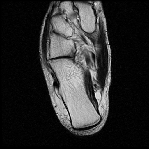 File:Anterior calcaneal process fracture (Radiopaedia 71377-81705 Axial T2 13).jpg
