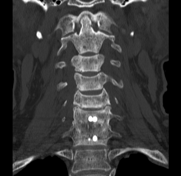 Anterior cervical postdiscectomy arthrodesis (Radiopaedia 32678-33646 Coronal bone window 23).jpg