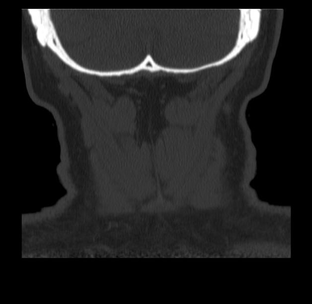 Anterior cervical postdiscectomy arthrodesis (Radiopaedia 32678-33646 Coronal bone window 75).jpg