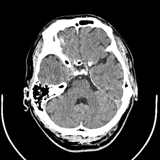 Anterior choroidal artery infarct (Radiopaedia 55106-61480 Axial non-contrast 14).jpg