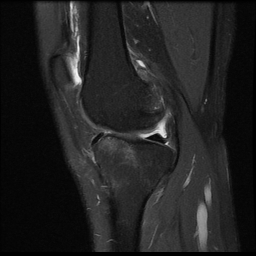 File:Anterior cruciate ligament avulsion fracture (Radiopaedia 58939-66193 Sagittal PD fat sat 14).jpg
