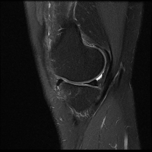 File:Anterior cruciate ligament avulsion fracture (Radiopaedia 58939-66193 Sagittal PD fat sat 16).jpg