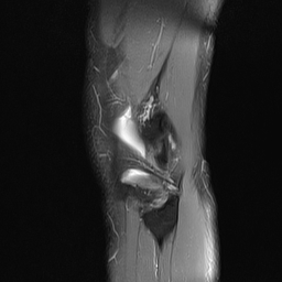File:Anterior cruciate ligament full thickness tear (Radiopaedia 66268-75467 Sagittal PD fat sat 21).jpg