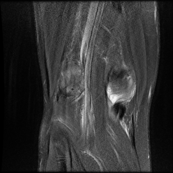 File:Anterior cruciate ligament graft tear and bucket-handle tear of medial meniscus (Radiopaedia 75867-87255 Coronal PD fat sat 22).jpg