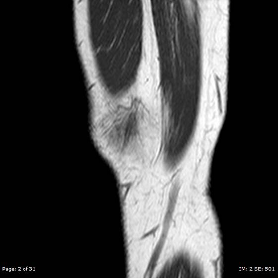 File:Anterior cruciate ligament tear (Radiopaedia 70783-80964 Sagittal T1 2).jpg