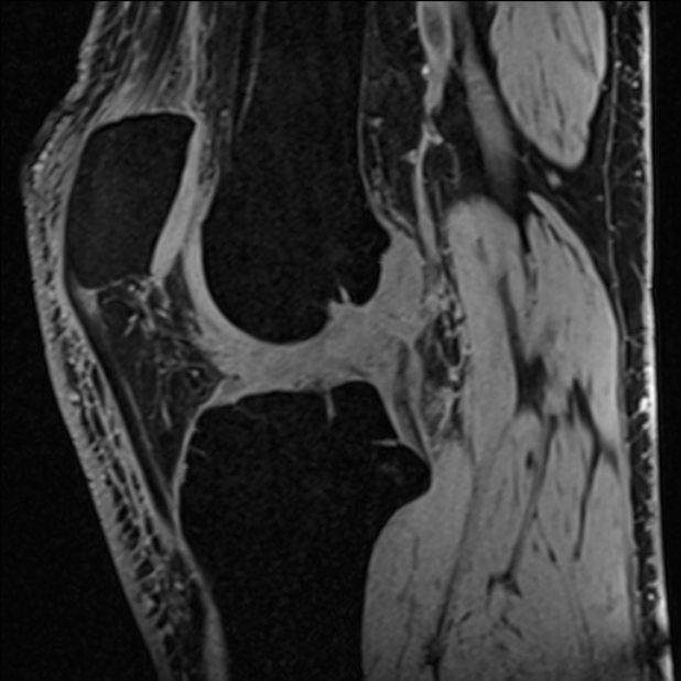 Anterior cruciate ligament tear - ramp lesion (Radiopaedia 71883-82322 Sagittal T1 vibe 73).jpg