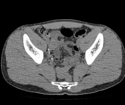 File:Anterior inferior iliac spine avulsion fracture (Radiopaedia 81312-94999 Axial non-contrast 41).jpg