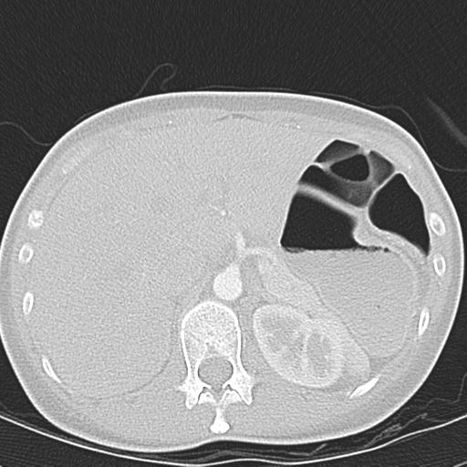 Anterior mediastinal lymphoma (Radiopaedia 29556-30061 Axial lung window 57).jpg