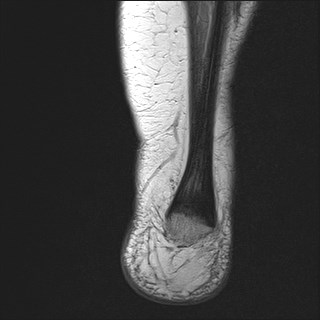 File:Anterior talofibular ligament injury - rupture with soft-tissue impingement (Radiopaedia 38765-40928 Coronal PD 2).jpg
