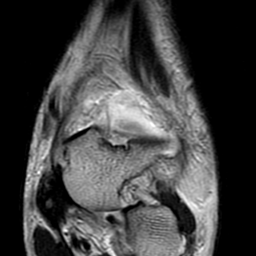 File:Anterior talofibular ligament rupture (Radiopaedia 15831-15484 Coronal T2 6).jpg