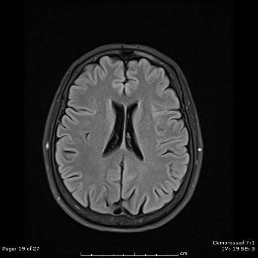 File:Anterior temporal lobe perivascular space (Radiopaedia 88283-104914 Axial FLAIR 19).jpg