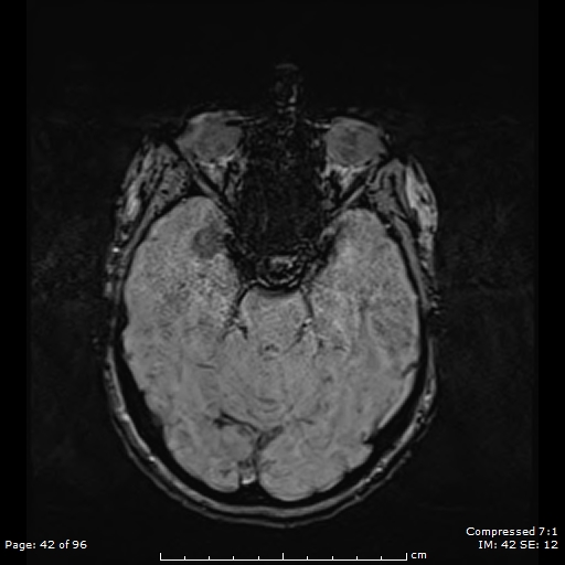 File:Anterior temporal lobe perivascular space (Radiopaedia 88283-104914 Axial SWI 11).jpg
