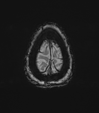 Anterior temporal pole cysts (Radiopaedia 46629-51102 Axial SWI 83).png