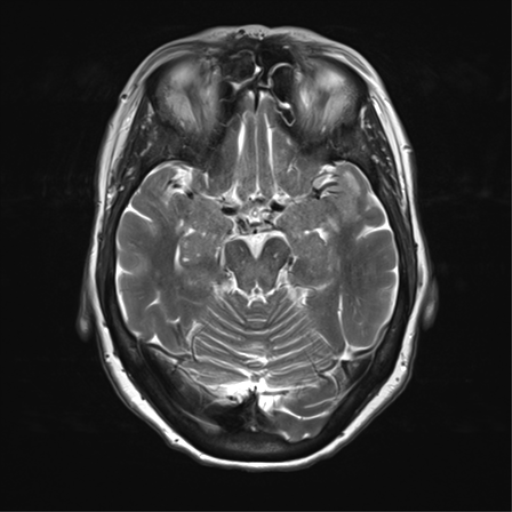File:Anterior temporal pole cysts (Radiopaedia 46629-51102 C 15).png