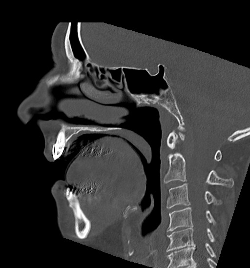 Anterior temporomandibular joint dislocation (Radiopaedia 59430-66784 B 34).jpg