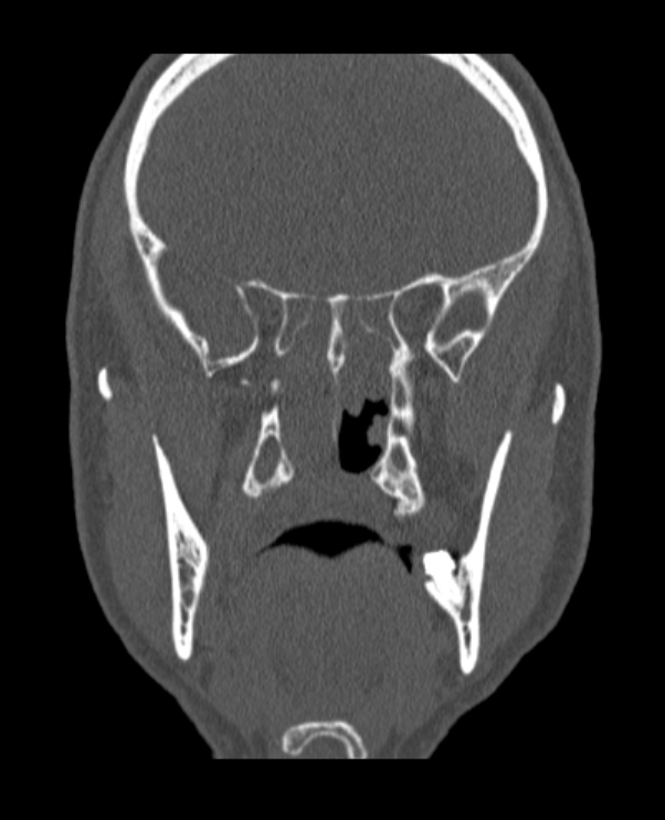 Antrochoanal polyp (Radiopaedia 79011-92169 Coronal bone window 31).jpg