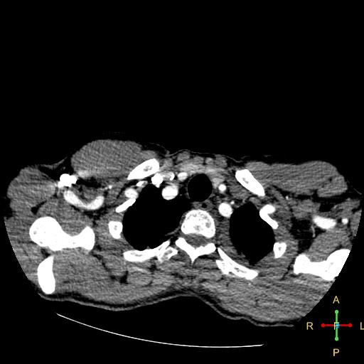 File:Aortic aneurysm and penetrating ulcer (Radiopaedia 23590-23704 A 2).jpg