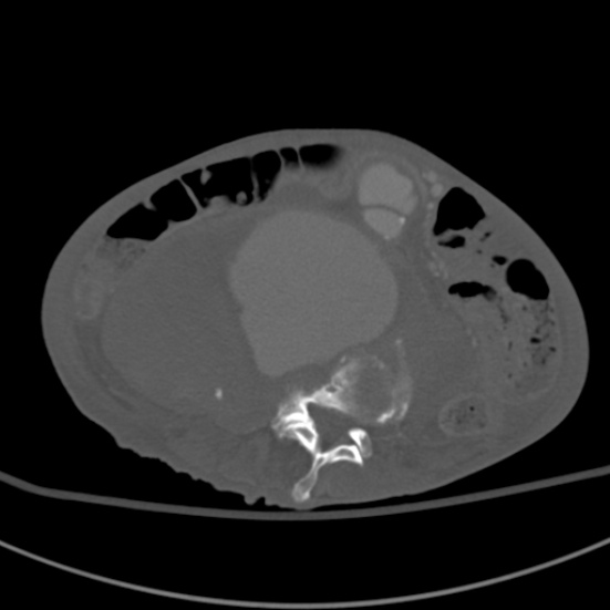 Aortic aneurysm with spinal destruction (Radiopaedia 42301-45410 Axial bone window 58).jpg