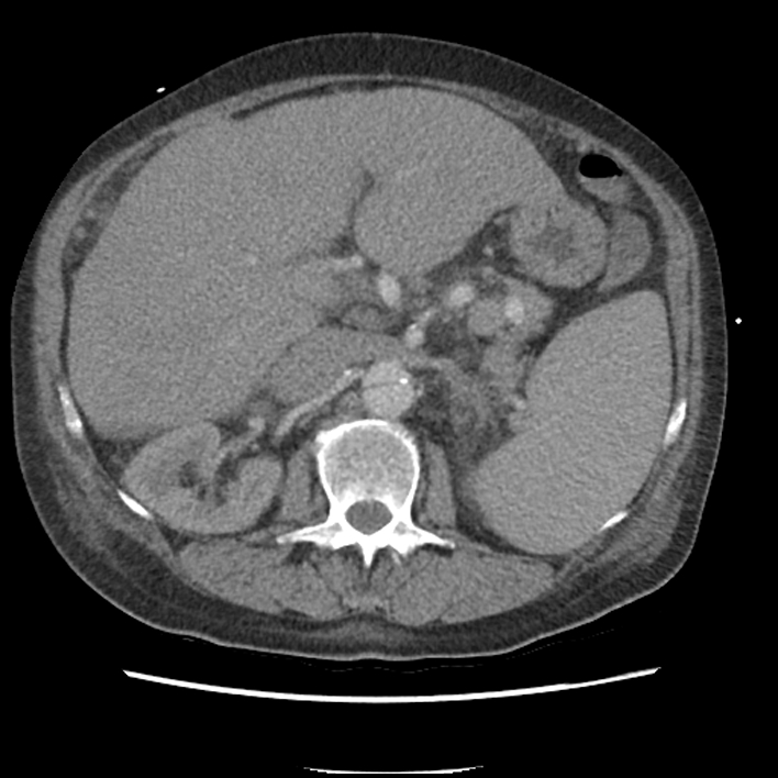 Aortic arch graft infection (FDG PET-CT) (Radiopaedia 71975-82437 A 71).jpg